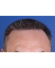 After Hair Transplant &nbsp;2 Sessions (Areas)